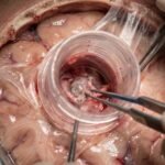 Microscopic resection of a brain lesion using a DIY tubular syringe retractor in a minimally invasive brain surgery